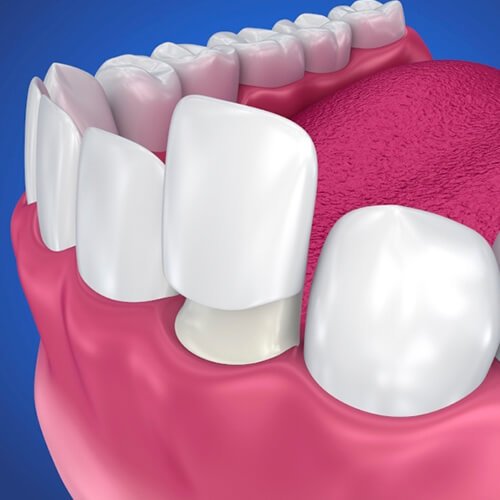 Естетична стоматология – избелване, фасети, бондинг